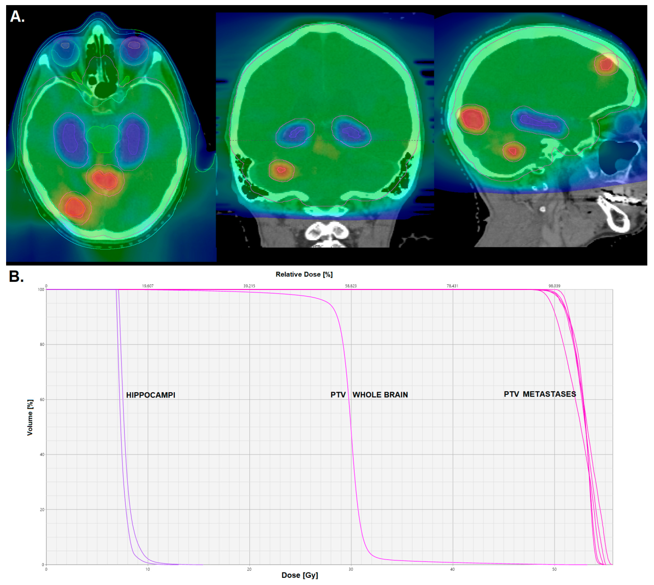 Do We Still Need Whole-Brain Irradiation for Brain Metastases? – Castalia Fernández