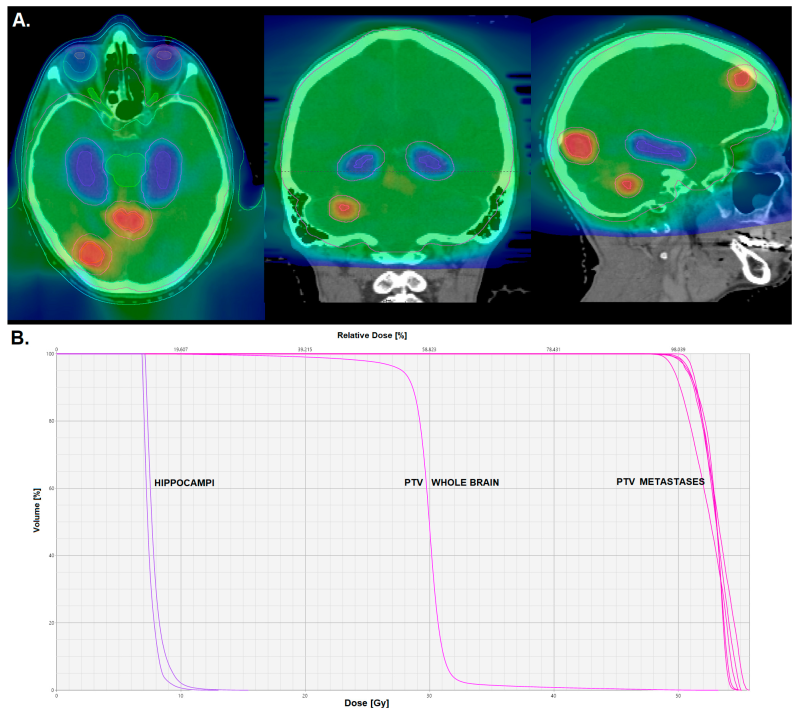 Do We Still Need Whole-Brain Irradiation for Brain Metastases? – Castalia Fernández
