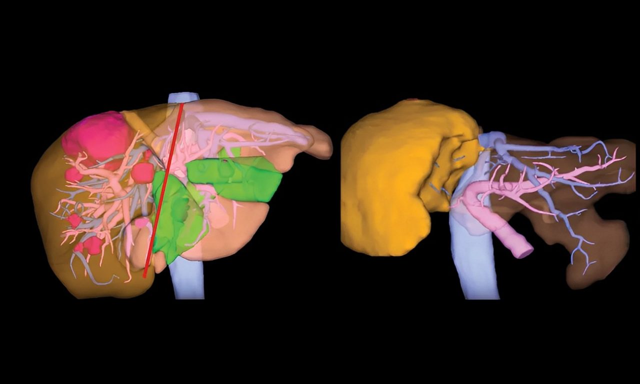 A surgery performed at the Johns Hopkins Hospital could reduce cancer recurrence and improve survival for patients with liver metastasis from advanced colorectal cancer