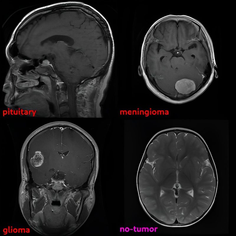 We’ve just achieved a stunning 92% accuracy in brain tumor classification using an unsupervised method – FiveBrane