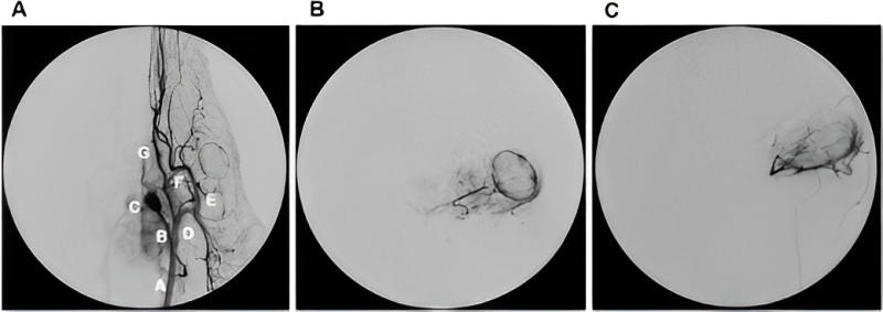 Guillermo Chantada: Great study of an animal model for testing the orbital disposition of topotecan after intra-arterial administration