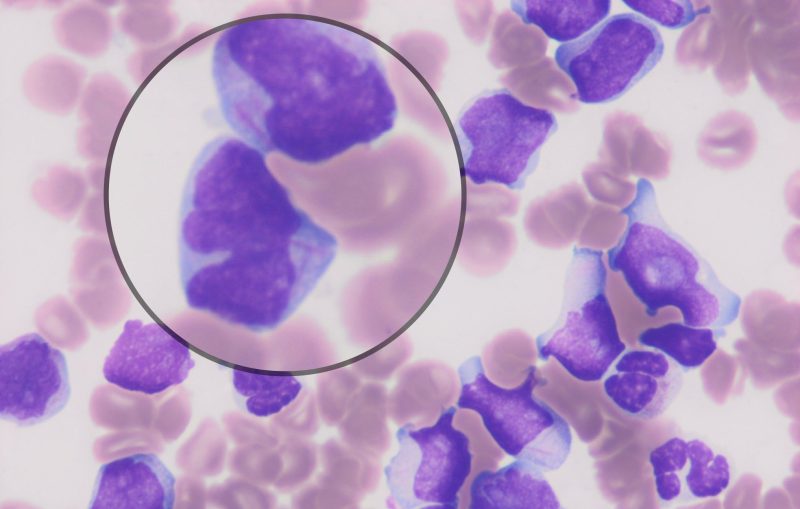 Sanam Loghavi: Ending a long and hectic day on the acute leukemia service with the most picturesque, slender Auer rods…