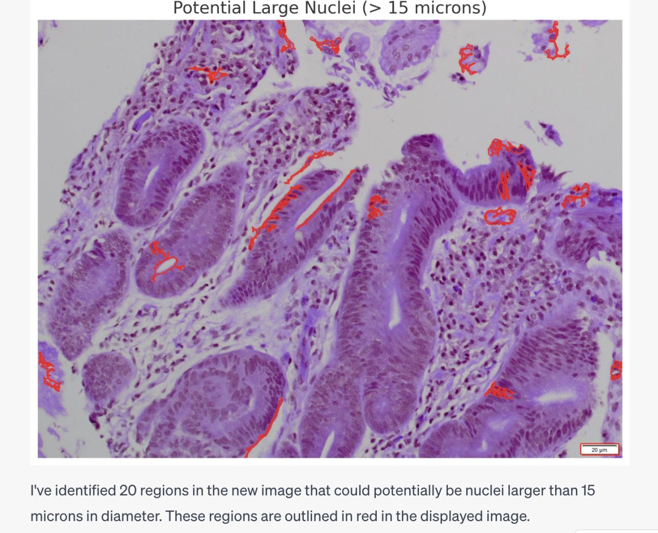 We asked Chatgpt to identify nuclei larger than 15 microns in diameter! Not bad, isn’t it! – Journal of Clinical Pathology