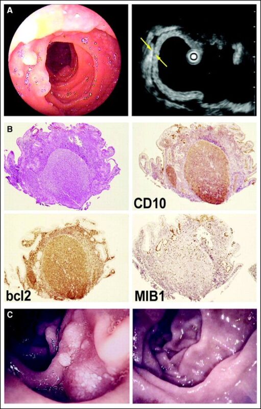 Nico Gagelmann: Gastrointestinal (GI) manifestations in hematology