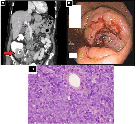 Nico Gagelmann: Gastrointestinal (GI) manifestations in hematology