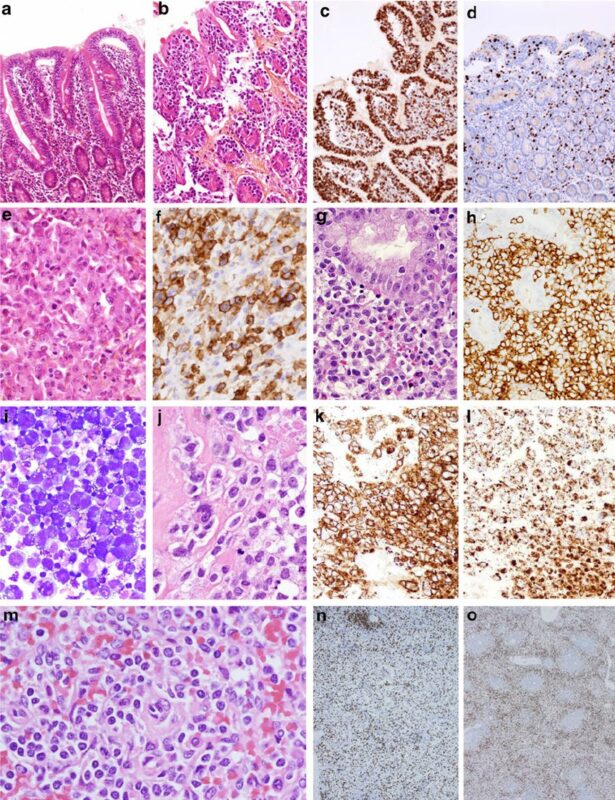 Nico Gagelmann: Gastrointestinal (GI) manifestations in hematology