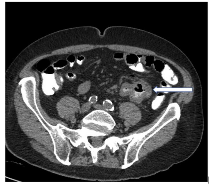 Nico Gagelmann: Gastrointestinal (GI) manifestations in hematology