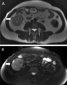 Nico Gagelmann: Gastrointestinal (GI) manifestations in hematology