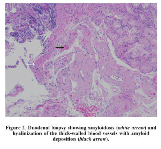 Nico Gagelmann: Gastrointestinal (GI) manifestations in hematology