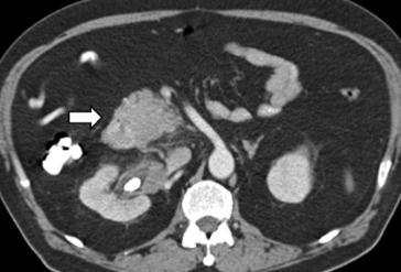 Nico Gagelmann: Gastrointestinal (GI) manifestations in hematology