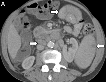 Nico Gagelmann: Gastrointestinal (GI) manifestations in hematology