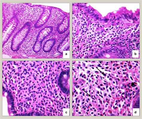 Nico Gagelmann: Gastrointestinal (GI) manifestations in hematology