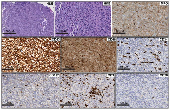 Nico Gagelmann: Gastrointestinal (GI) manifestations in hematology