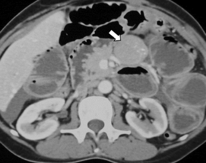 Nico Gagelmann: Gastrointestinal (GI) manifestations in hematology