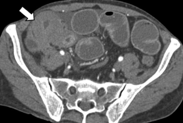 Nico Gagelmann: Gastrointestinal (GI) manifestations in hematology