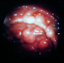 Nico Gagelmann: Gastrointestinal (GI) manifestations in hematology