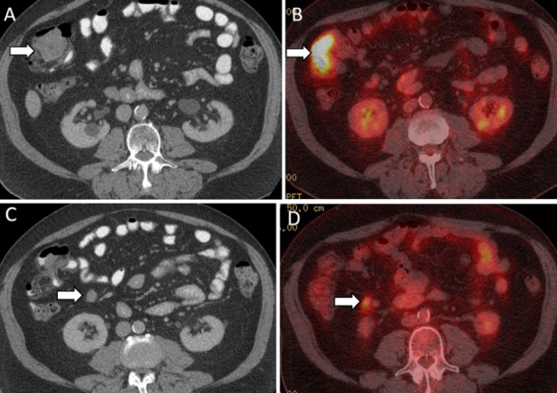 Nico Gagelmann: Gastrointestinal (GI) manifestations in hematology