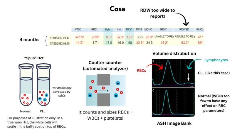 William Aird: SPURIOUS MACROCYTOSIS FROM HYPERLEUKOCYTOSIS