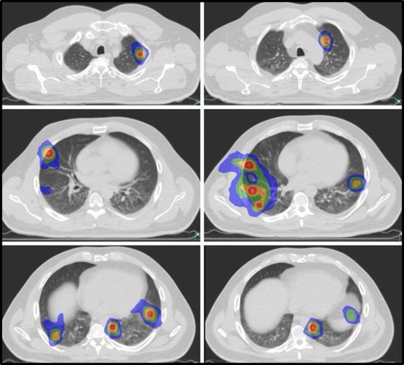 David Palma: Today we completed accrual for the SABR-COMET-10 trial!