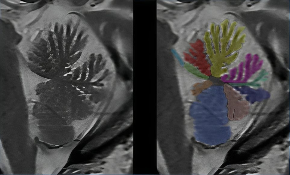 Lea Alhilali: How much cerebellar anatomy do YOU know?