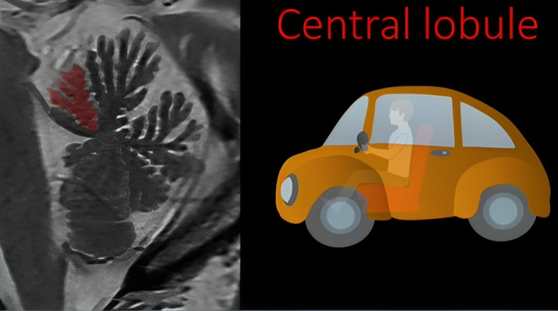 Lea Alhilali: How much cerebellar anatomy do YOU know?