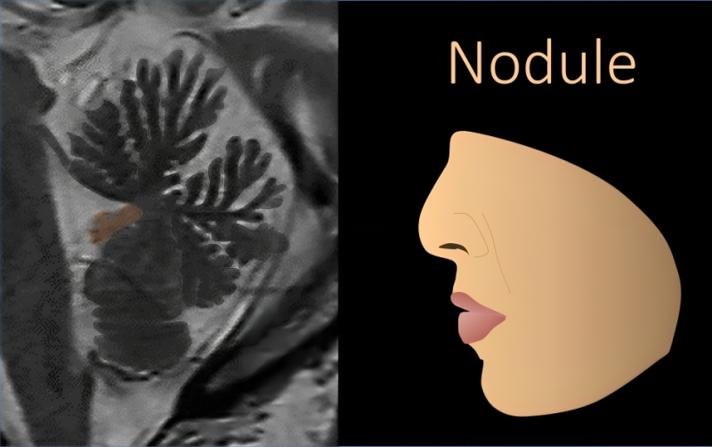 Lea Alhilali: How much cerebellar anatomy do YOU know?