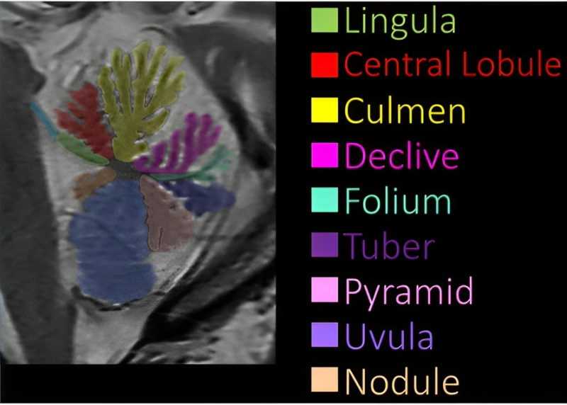 Lea Alhilali: How much cerebellar anatomy do YOU know?