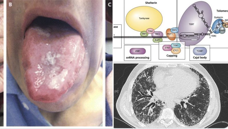 Aaron Goodman: Dyskeratosis Congenita!
