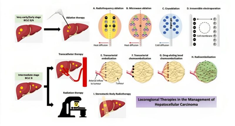 Ada Zhong: Nice review by Janet Wui Cheung Kung and Kelvin Kwok Chai Ng