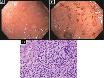 Nico Gagelmann: Gastrointestinal (GI) manifestations in hematology