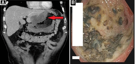 Nico Gagelmann: Gastrointestinal (GI) manifestations in hematology