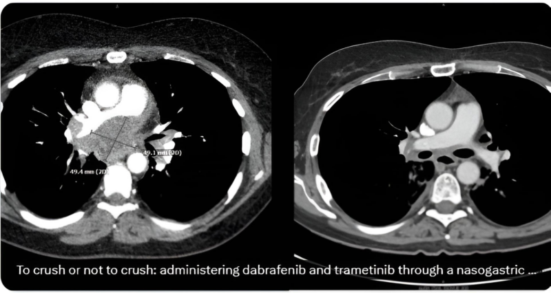 Stephen V Liu: Need more data on PKs with crushing TKI pills