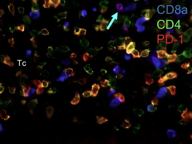 Pashtoon Kasi: This starry sky is what the immune cells look like gathering around a cancer that’s getting killed