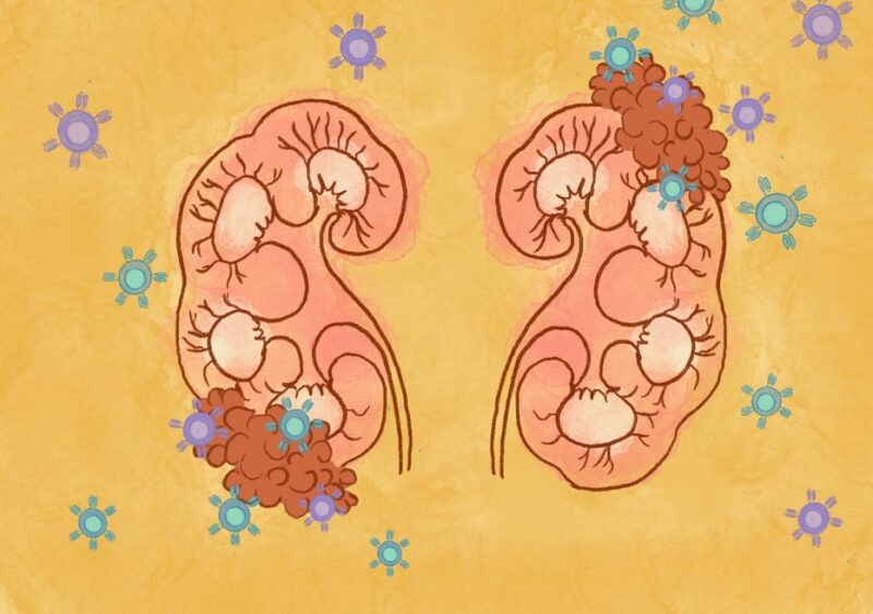 CD70-Targeted Allogeneic CAR T-Cell Therapy for Advanced Clear Cell Renal Cell Carcinoma, by Sumanta K. Pal et al – Cancer Discovery