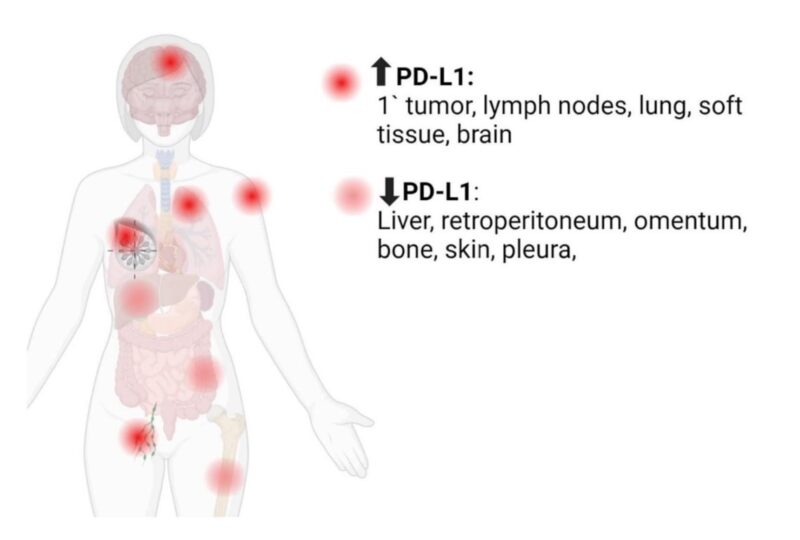 Arya Roy: Such an interesting finding! PD-L1 positivity varies by metastatic location in mTNBC!