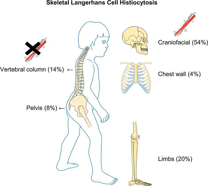 Langerhans Cell Histiocytosis