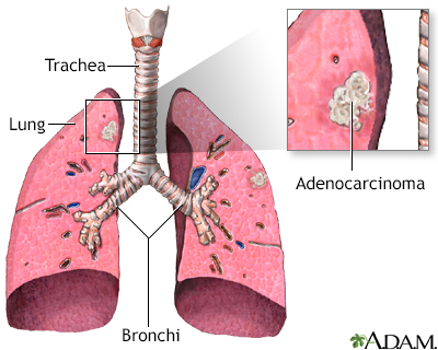 Adenocarcinoma of the lung