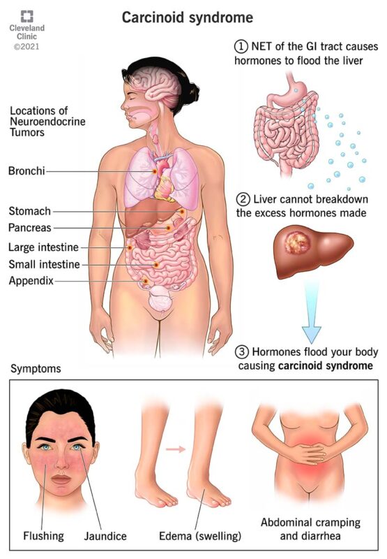 Carcinoid-Syndrome