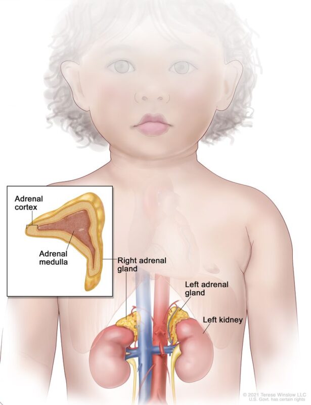 Pheochromocytoma in Children: What patients and caregivers should know about