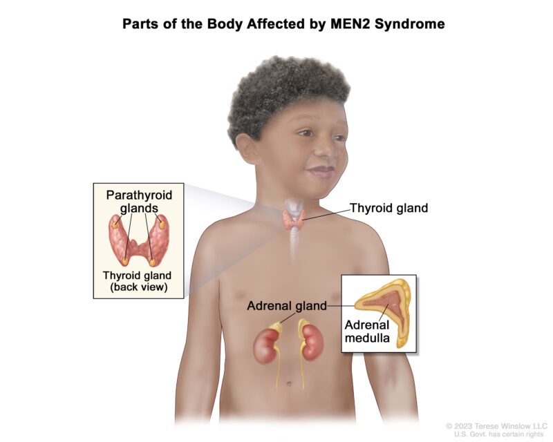 Multiple Endocrine Neoplasia Type 2A (MEN2A): What patients should know about