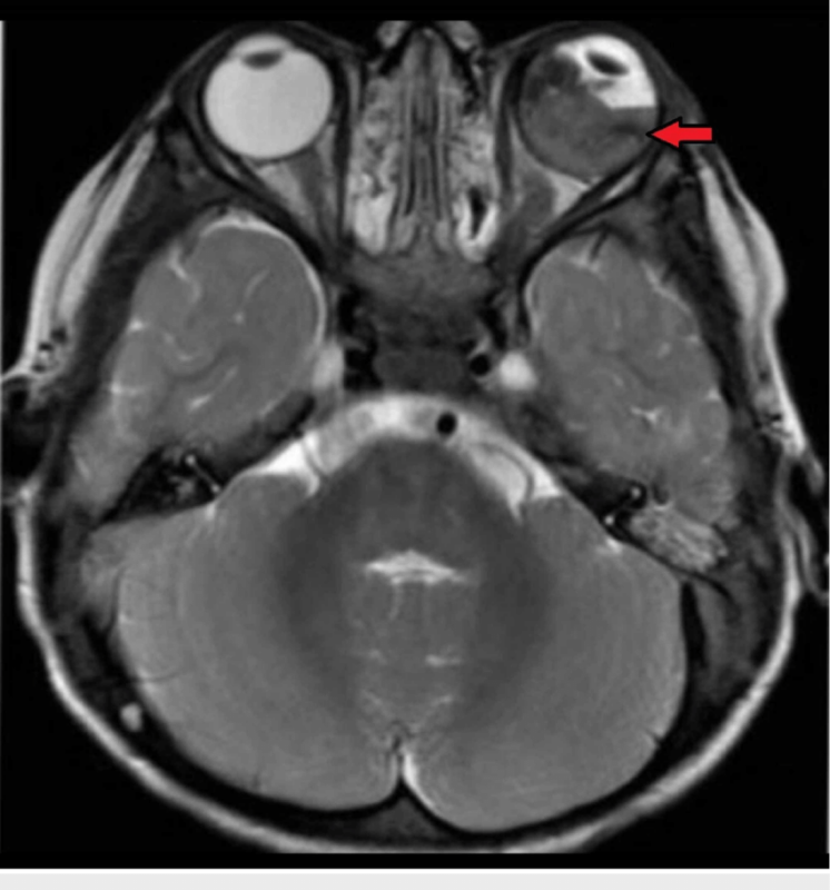 Axial T2-weighted MRI of the brain and orbit showing retinoblastoma in left eye along with retinal detachment (red arrow)