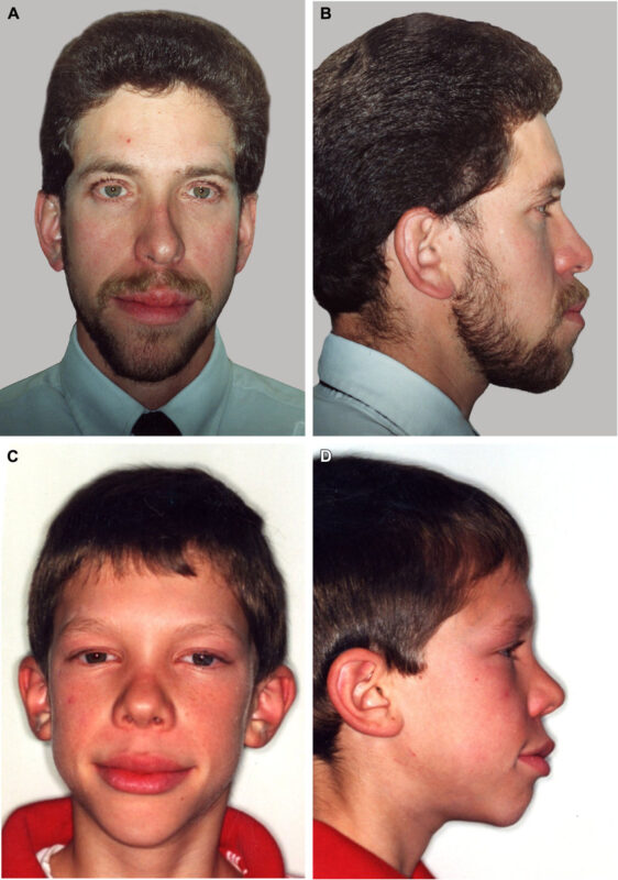 Multiple Endocrine Neoplasia Type 2B (MEN2B): What patients should know about