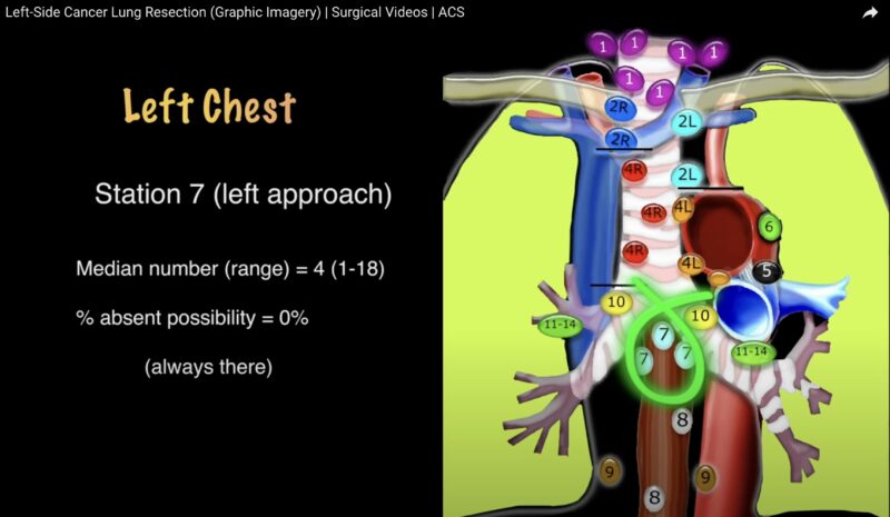 Drew Moghanaki: How mediastinal LNs are sampled during lung surgery