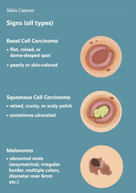 Shahrin Ahmed raises awareness on Melanoma skin cancer cases rising in UK