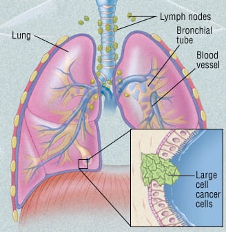 large cell lung carcinoma