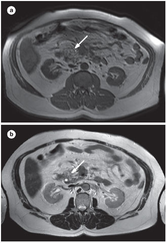 carcinoid tumor