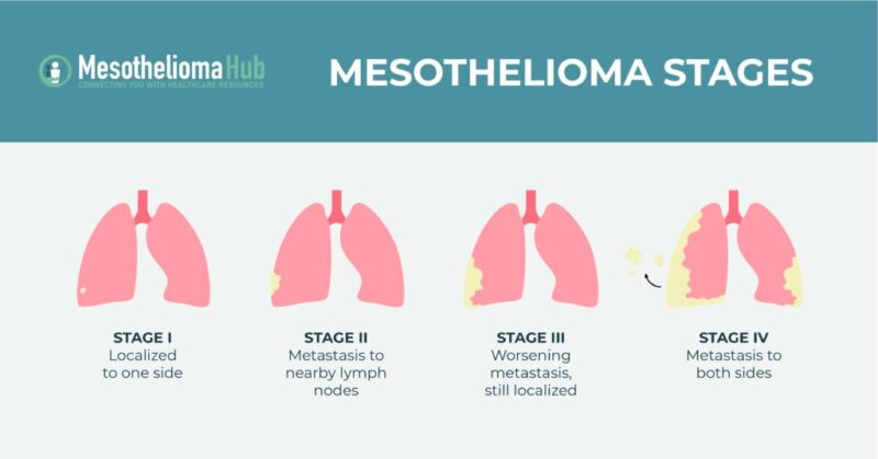 Mesothelioma in Adults: What patients should know about