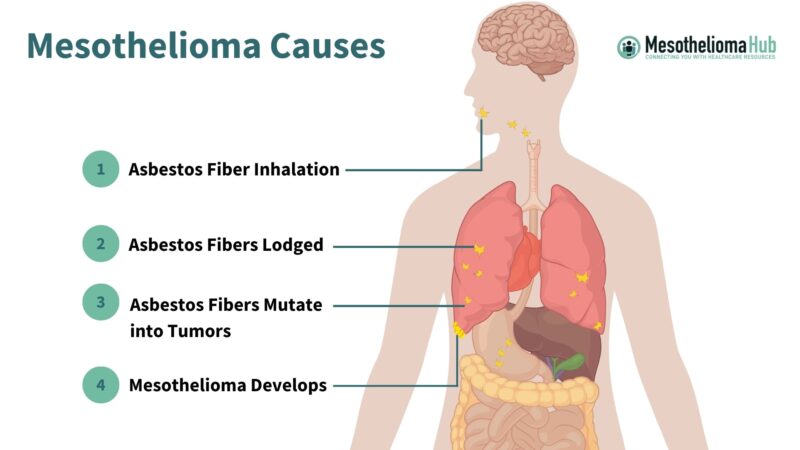 Mesothelioma in Adults: What patients should know about