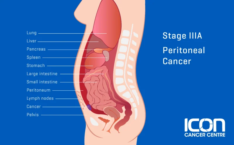 Primary Peritoneal Cancer