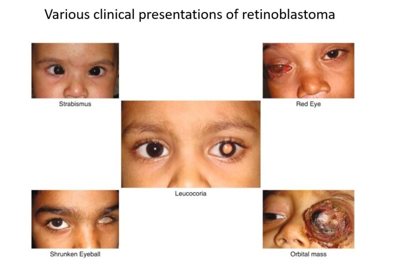 Clinical symptoms of retinoblastoma